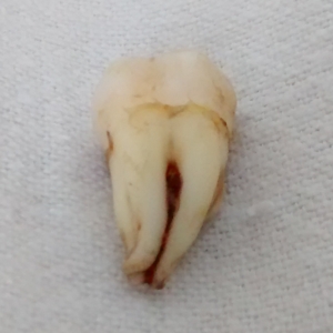 Wisdom tooth 1