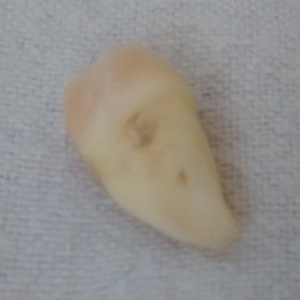 Wisdom tooth 2