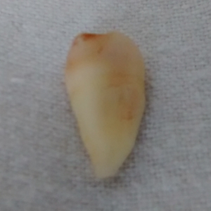 Wisdom tooth 2