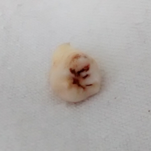 Wisdom tooth 2