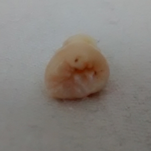 Wisdom tooth 3