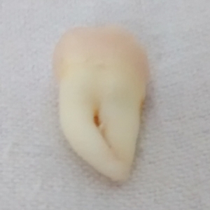 Wisdom tooth 3