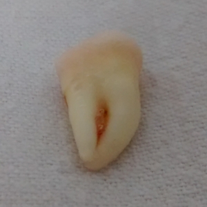 Wisdom tooth 3