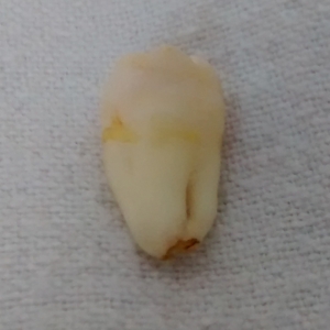 Wisdom tooth 4