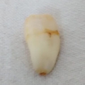 Wisdom tooth 4