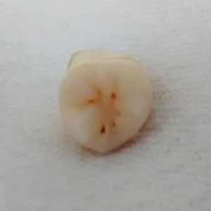 Wisdom tooth 4